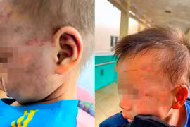 Tạm giữ cha dượng đánh bé 3 tuổi bầm tím mặt mũi