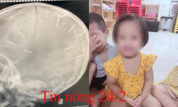 Tin nóng 24/2: Sức khỏe bé gái bị găm 9 đinh vào đầu giờ ra sao?