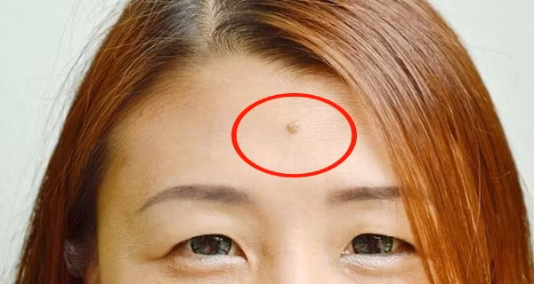 Tuy nhiên, nếu nó mọc gần Cung Quan Lộc ở hai bên trái và phải, đó là nốt ruồi hiếm gặp và tốt lành, khi đến thời điểm, bạn nhất định sẽ giàu có!