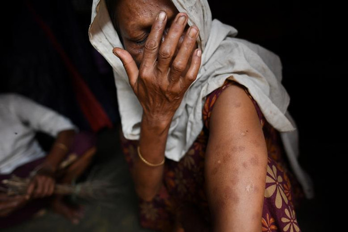 Một phụ nữ tị nạn Rohingya giơ cánh tay đầy vết thương tại khu trại tị nạn Shamlapur ở Cox's Bazaar, Bangladesh, ngày 26/3/2018.