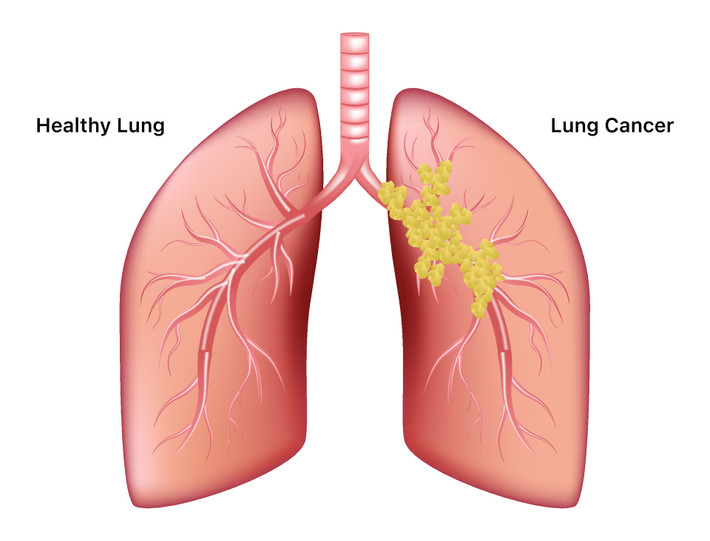 Đặc biệt là bệnh ung thư phổi rất khó phát hiện trong giai đoạn đầu. Ảnh: SCC.