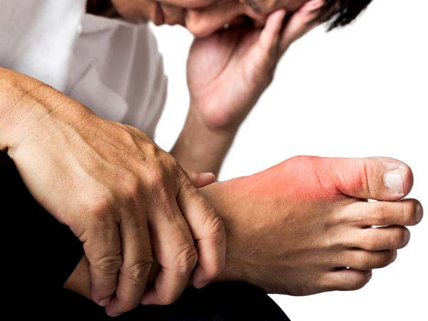 1. Người mắc bệnh gút: Bệnh gút là bệnh do rối loạn chuyển hóa nhân purin. Bệnh nhân sẽ bị tăng axit uric máu. Do chế độ ăn nhiều dầu mỡ sẽ làm giảm quá trình bài tiết axit uric và khiến tình trạng bệnh nặng hơn nên người bệnh gút không nên ăn lạc. Ảnh: Boldsky.