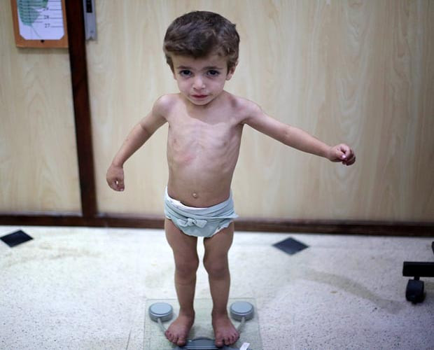 Hình ảnh những em bé Syria với thân hình gầy gò do bị suy dinh dưỡng khiến nhiều người không khỏi xót xa. Đó cũng là hồi chuông báo động về cuộc khủng hoảng lương thực trầm trọng tiếp diễn tại quốc gia Trung Đông này. Ảnh: Getty Images.