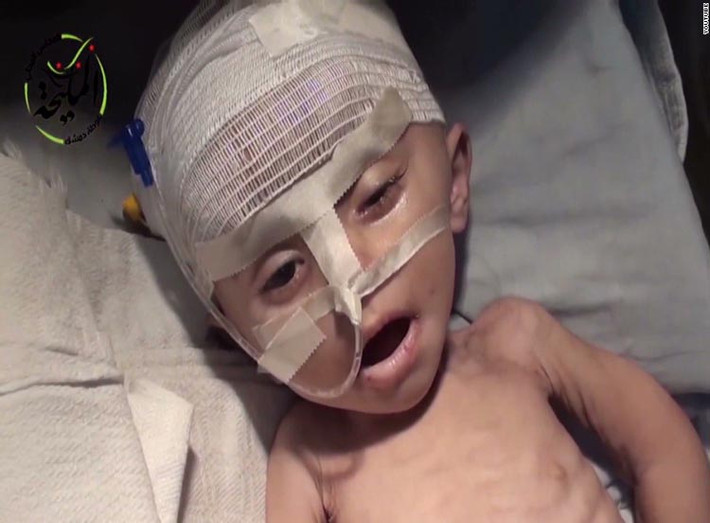 Bức ảnh em nhỏ suy dinh dưỡng ở Syria đang hấp hối gây đau lòng. Ảnh: CNN.