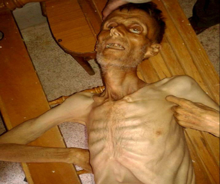 Thân hình “gầy trơ xương” của một người đàn ông Syria.
