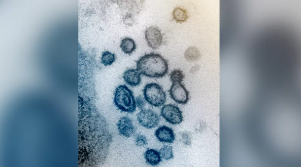 10. Virus SARS-COV-2: Virus SARS-COV-2 gây bệnh COVID-19 đã trở thành nguyên nhân gây tử vong do virus hàng đầu kể từ khi dịch bùng phát vào năm 2020. Tính đến tháng 10/2022, virus đã khiến hơn 6,57 triệu người tử vong và còn tiếp tục tăng. Theo OurWorldInData, virus này đã lây nhiễm cho ít nhất 626 triệu người. Ảnh: Getty.