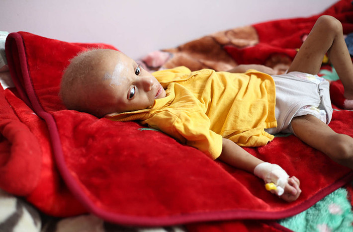 Được biết, khoảng 22,2 triệu người Yemen đang phải sống phụ thuộc vào viện trợ nhân đạo. Ngoài ra, khoảng 16 triệu người không được tiếp cận với nước sạch và y tế, 4,5 triệu trẻ em có thể không được đến trường. Ảnh: AJ.