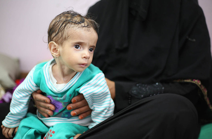 Nhiều trẻ em Yemen bị suy dinh dưỡng trầm trọng. Ảnh: Bé Fatima 1 tuổi nhưng chỉ nặng 4,2 kg. Ảnh: AJ.