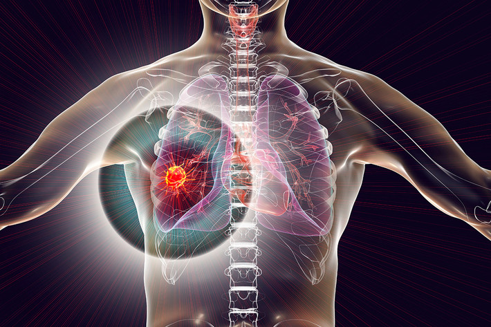 Điều này có nghĩa là, ung thư phổi thường chỉ được phát hiện sau khi đã di căn. Ảnh: Shutterstock.