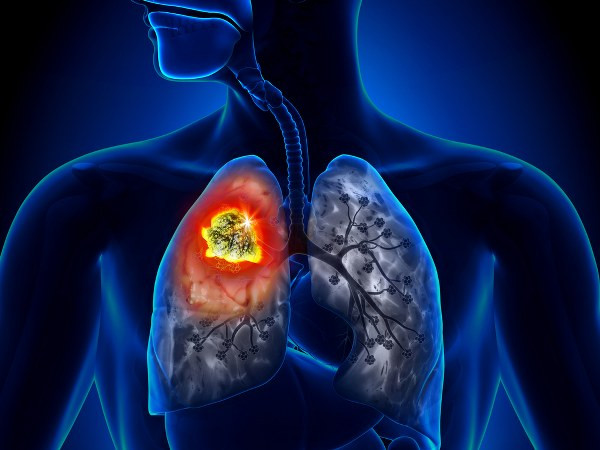 Nếu một khối u nằm ở đỉnh phổi, nó có thể tạo áp lực lên các dây thần kinh và mạch máu dẫn tới cánh tay, khiến người bệnh cảm thấy đau và yếu ở các chi. Ảnh: BT.