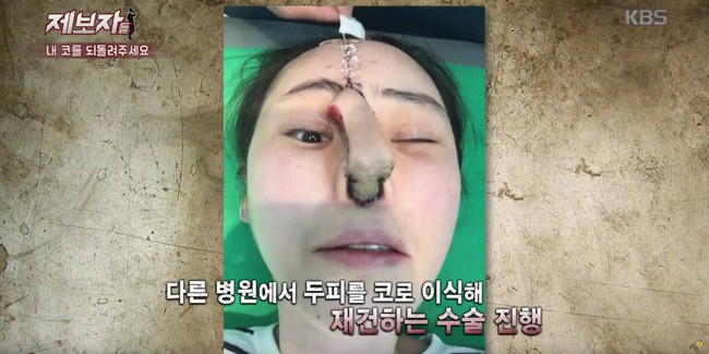 Kim Min Joo (33 tuổi) đến từ Hàn Quốc đã khiến người nhiều người thương cảm khi gặp phải sự cố đáng tiếc khi phẫu thuật thẩm mỹ nâng mũi. Được biết, Kim mắc bệnh viêm mũi nên đã đến một bệnh viện chuyên về tai mũi họng để chữa trị. Tuy nhiên, trong quá trình tư vấn, bệnh viện này lại một mực khuyên cô gái trẻ nên thực hiện phẫu thuật thẩm mỹ để có chiếc mũi cao hơn. Kim đồng ý và đã trải qua ca phẫu thuật thẩm mỹ một cách an toàn.
