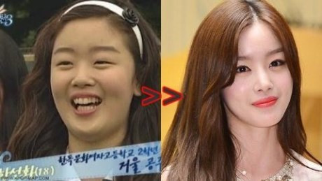 Cô nàng Sunhwa của nhóm nhạc Secret lột xác thành thiên nga nhờ sự tiến bộ của ngành làm đẹp xứ Kim chi. Khác với vẻ thô kệch và những nét thiếu hài hòa trên khuôn mặt thuở xưa, khuôn mặt của sao Châu Á này giờ đây vô cùng nổi bật với chiếc mũi cao cùng chiếc cằm thon gọn.