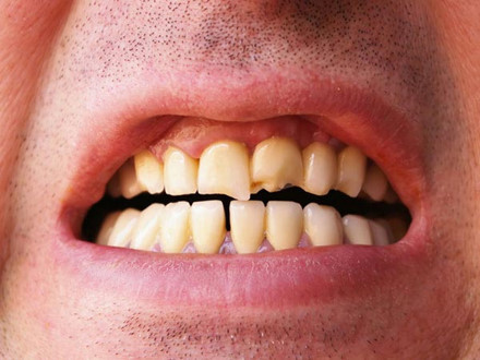Thưa răng: Sử dụng tăm thường xuyên sẽ tạo ra một khoảng trống ở giữa các răng. Điều này sẽ tạo cơ hội cho các loại thức ăn mắc kẹt ở răng dễ dàng hơn, từ đó dẫn đến sự hình thành các hốc răng sâu.