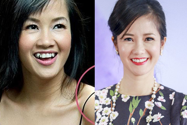 "Cô Bống" Hồng Nhung nổi tiếng một thời với chiếc răng khểnh duyên dáng, tuy nhiên vì sợ bị ảnh hưởng đến sức khỏe nên cô đã quyết định tìm đến các nha sĩ để có được hàm răng đều tăm tắp.