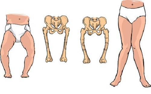 Người không ăn rau ngót. Bệnh nhân thiếu canxi và phốt pho. Người thiếu canxi và phốt pho thì không nên ăn rau ngót bởi nó cản trở sự hấp thụ của 2 loại chất này. Ngoài việc hỗ trợ cho quá trình trao đổi chất trong cơ thể, glucocorticoid, là kết quả của quá trình trao đổi chất của lá rau ngót, có thể gây cản trở cho quá trình hấp thụ canxi và phốt pho. Nó cản trở cả hai vi chất này trong chính lá rau ngót cũng như trong thực phẩm khác ăn kèm.