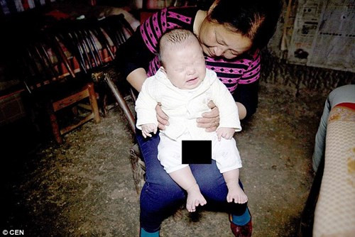 Tuy nhiên, khi em bé chào đời, cha mẹ em đã bị sốc khi chứng kiến con mình mắc dị tật còn nghiêm trọng hơn cả mẹ. Mỗi bàn chân của em bé có 8 ngón; một tay có 8 ngón và tay còn lại có 7 ngón. Theo Dailymail, cứ 1.000 ca sinh thì có 1 ca mắc dị tật thừa ngón. Tuy nhiên, trường hợp thừa nhiều ngón như của bé Hồng Hồng là cực kì hiếm.