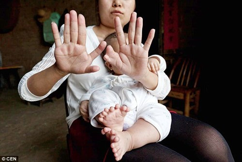 Theo truyền thông địa phương, mẹ của Hồng Hồng cũng mắc dị tật thừa ngón. Vì lo con mình có thể bị giống mẹ nên ngay từ khi mang thai, chị thường xuyên đi khám tại các bệnh viện ở Thâm Quyến. Chị cũng từng đi siêu âm 4 chiều tại bệnh viện phụ sản quận Futian ở Thâm Quyến và kết quả là không phát hiện bất thường nào.