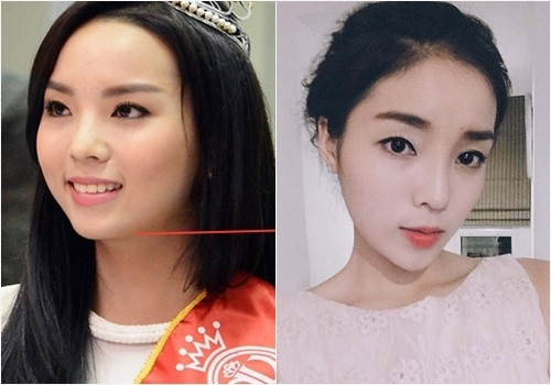 Hoa hậu Kỳ Duyên khiến dư luận dậy sóng trước tin đồn thẩm mĩ. Đó là bởi chiếc cằm nhọn, sống mũi cao nhọn bất thường nhưng không thể phủ nhận được Hoa hậu Việt Nam 2014 đẹp lên thấy rõ.