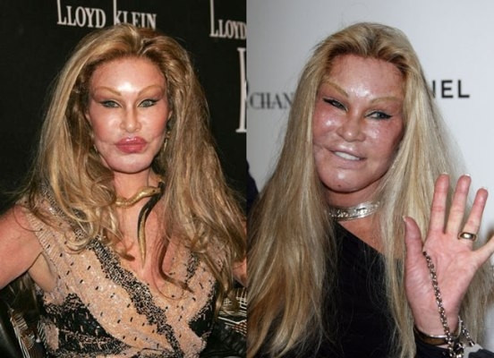 Jocelyn Wildenstein từng là mỹ nhân của làng giải trí thế giới những năm 1970. Tuy nhiên sau khi quyết định phẫu thuật thẩm mỹ để giành lại chồng từ tay tình địch thì nhan sắc của cô đã trở thành thảm họa.