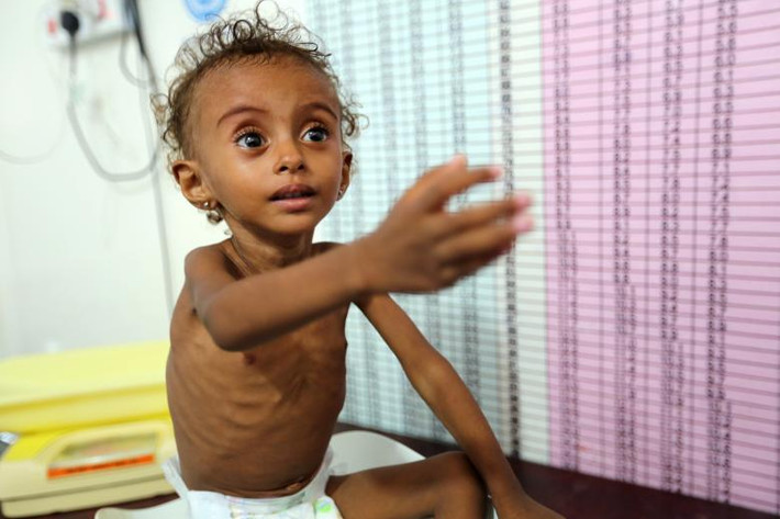 Hình ảnh về những em nhỏ Yemen gầy trơ xương khiến nhiều người không khỏi xót xa. Trong ảnh là bé Ferial Elias, 2 tuổi, bị suy dinh dưỡng và đang được điều trị tại bệnh viện al-Thawra.