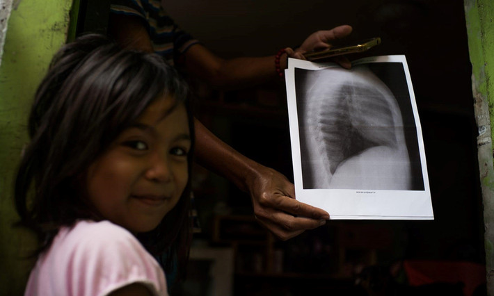 Shantal, 5 tuổi, đã được chẩn đoán viêm phổi ba lần. Ở làng Canumay West của Valenzuela, rác thải nước ngoài là vấn đề cá nhân. Một tỷ lệ đáng kể chất thải nhựa được tái chế trong các nhà máy trong thành phố đến từ các quốc gia khác. Chất thải được tìm thấy trong các khu vực công nghiệp như thành phố Valenzuela thường được trộn với các nguyên liệu thô có nguồn gốc địa phương. Ảnh: Guardian.
