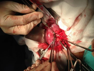 Những tai biến có thể xảy ra khi mổ sỏi thận