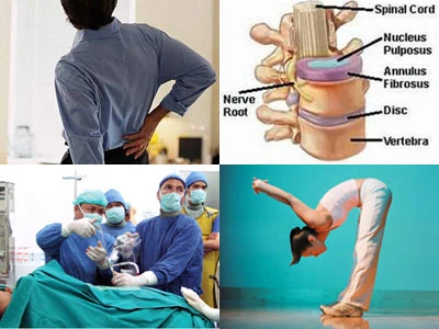 Những ai dễ bị thoát vị đĩa đệm như người mẫu Thái Hà?