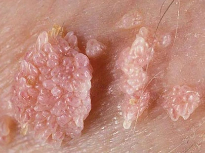 Dấu hiệu bệnh sinh dục rất dễ thấy trên da bạn