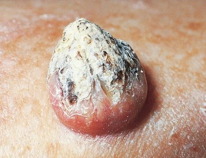 Phân biệt mụn nhọt thông thường với dấu hiệu ung thư da