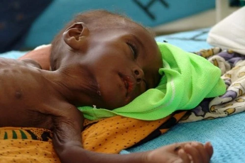 Dấu hiệu nguy hiểm con bạn suy dinh dưỡng nặng