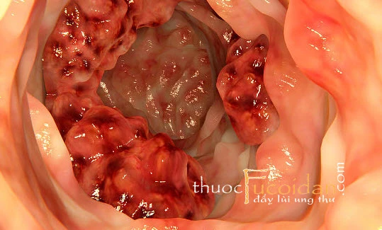 10 bệnh ung thư đàn ông Việt mắc nhiều nhất