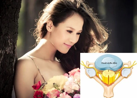 Căn bệnh của người mẫu Thái Hà có thể gây tàn phế
