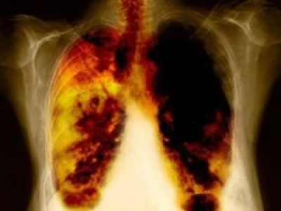 Những con số thống kê gây giật mình về bệnh ung thư