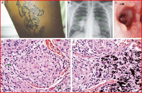 Cận cảnh quy trình sinh thiết phổi nghiêm ngặt, đáng sợ