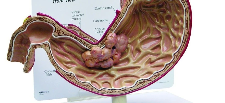  Tiết lộ nguyên nhân đàn ông Việt ung thư dạ dày nhiều nhất