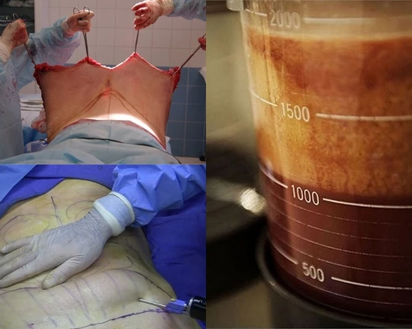 Rợn người xem cắt xẻo bụng mỡ bùng nhùng thành eo thon