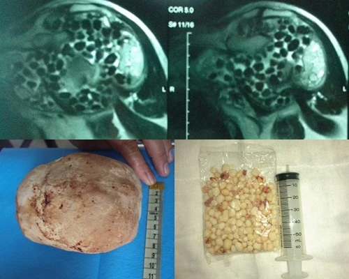 Rùng mình những viên sỏi “lúc nhúc” trong cơ thể