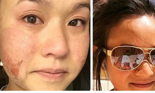 Hãi hùng thiếu nữ loét toàn thân sau khi nâng ngực