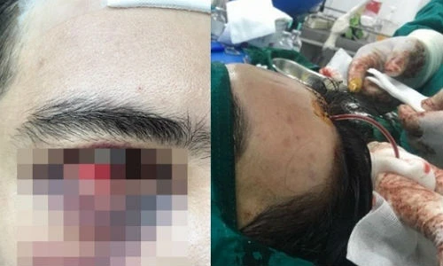 Hotboy bị tụ huyết sưng phù mắt vì phẫu thuật thẩm mỹ rởm