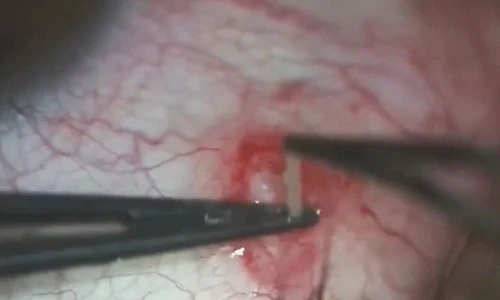 Ghê sợ hình ảnh bác sĩ gắp con giun sống 2 năm trong mắt người