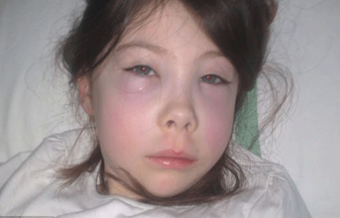 Mẹ của Lauryn đưa cô bé tới bệnh viện kiểm tra khi mặt và mắt cô bé sưng húp bất thường