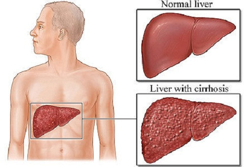 Sự xân lấn của virus đối với gan như virus viêm gan A, B, C lâu ngày cũng là quá trình phát bệnh của ung thư gan.