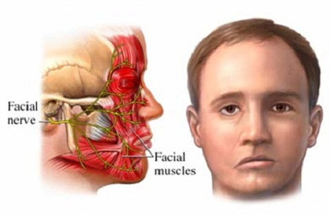 Một số bệnh nhân có biểu hiện: nửa mặt đỏ, khe mí mắt hẹp, đồng tử nhỏ, nhãn cầu tụt về phía sau.