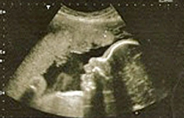 Kỳ diệu thai nhi tiêu diệt khối u giúp mẹ thoát chết