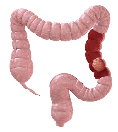 5 loại ung thư gây chết nhiều nhất