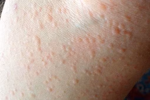 WHO cảnh báo: Nửa dân số thế giới có thể mắc dị ứng vào 2050