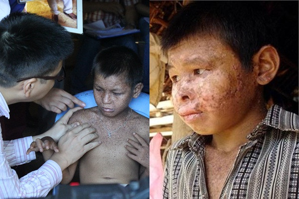 Bệnh tái đi tái lại nhiều lần, mùa hè bệnh nặng hơn. Bệnh thường lan từ đầu xuống má, miệng, mũi, cổ vai, lưng, quanh hốc mắt, gây ngứa ngáy, đau đớn cho người mắc bệnh...