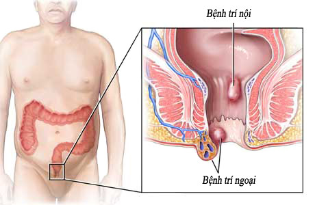 Bài thuốc này được đánh giá khá hiệu quả trong việc chữa bệnh trĩ. Bạn chỉ cần thực hiện liên tiếp 15 ngày các triệu chứng của bệnh giảm đáng kể.