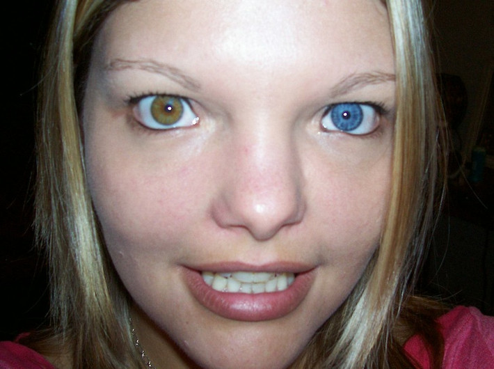 Hội chứng đột biến gen có tên là Heterochromia có thể khiến con người sở hữu đôi mắt hai màu khác nhau.