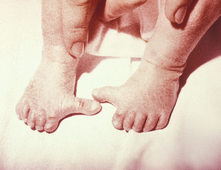 Tình trạng polydactyly (dị tật thừa ngón) khiến một số người có nhiều ngón chân hơn bình thường.